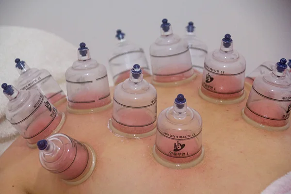 Cupping massage on the back